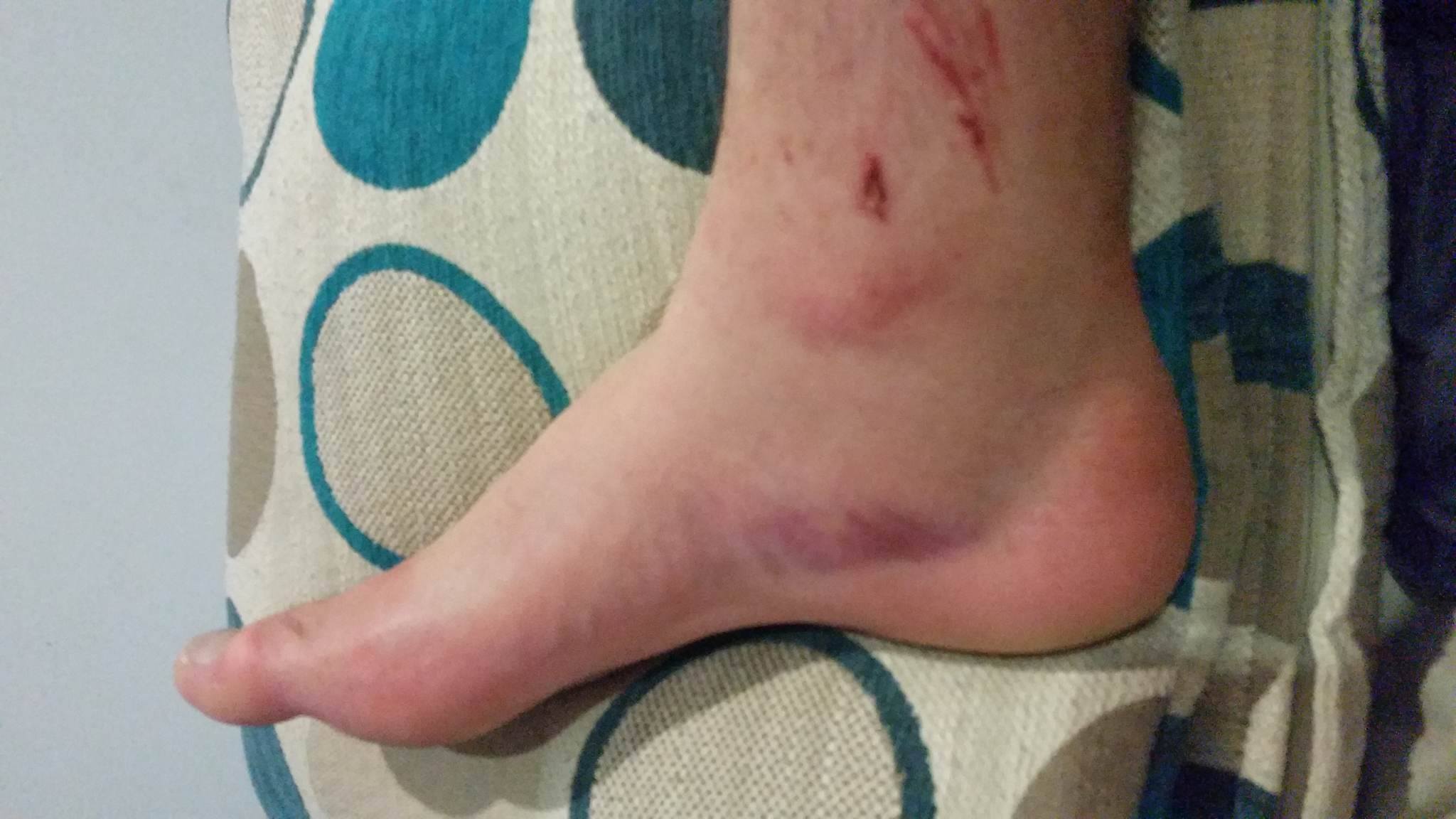 sprained ankle